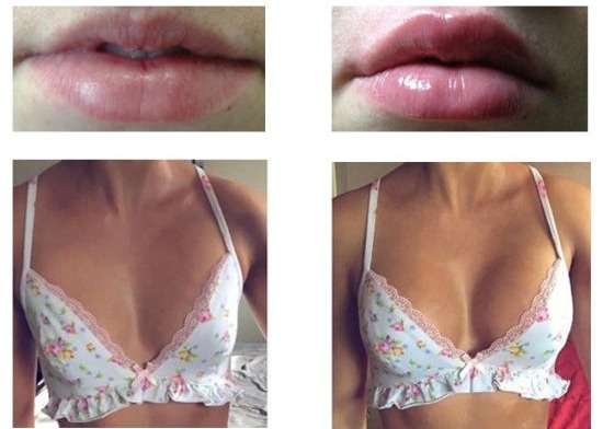 การฉีดฟิลเลอร์เสริมหน้าอกด้วยกรดไฮยาลูโรนิกการปลูกถ่ายริมฝีปาก Dermal Filler