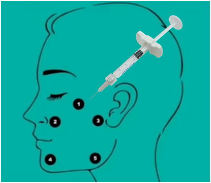 32mg H-HA L-HA Non Cross Linked กรดไฮยาลูโรนิกฟิลเลอร์ Hyaluronic Acid Gel