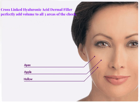 HA Gel Dermal Filler ที่มีประสิทธิภาพปลอดภัยสำหรับลดรอยแผลเป็นบนใบหน้า