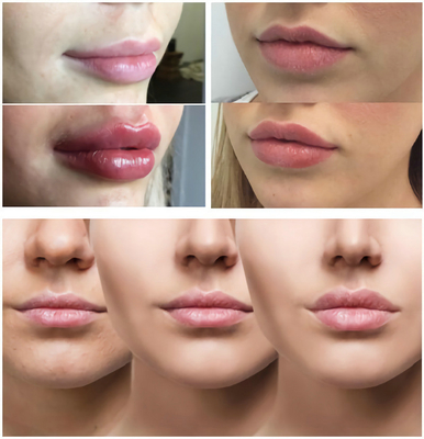 เส้นเรียบ / ริมฝีปากอวบอิ่มด้วยฟิลเลอร์ฉีดกรดไฮยาลูโรนิก 1ml 2ml 5ml