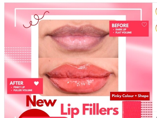 HYDROIAM Kiss with B12 Ha Filler Red Lips Filler Hyaluronic Acid Filler ให้ความกว้างและสีที่ธรรมชาติ