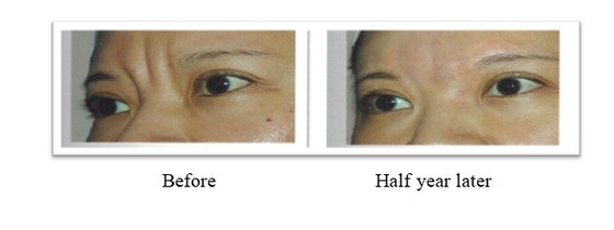 350 มิลลิกรัม 150 มิลลิกรัม PLLA Poly L Lactic Acid Dermal Filler สําหรับการรักษาริ้วรอยบนใบหน้า
