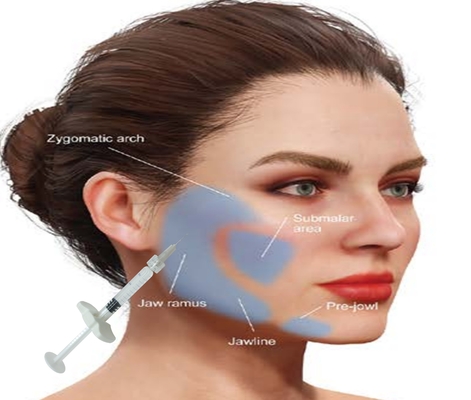 Hyaluronic Acid HA Calcium Hydroxyapatite Filler Get Natural Looking Face With 1ML Syringe ผสมผสมผสมผสมผสมผสมผสมผสมผสมผสมผสมผสมผสมผสมผสมผสมผสมผสมผสมผสมผสมผสมผสมผสมผสม