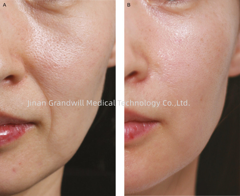 Miracle H L PCL Skin Booster สายละเอียด Polycaprolactone Hyaluronic Acid สารเติมฉีด