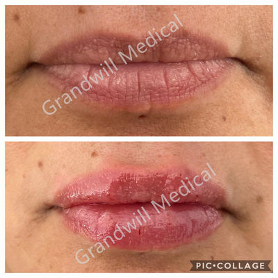 Lip Augmentation Injectable Hyaluronic Acid Gel ฟิลเลอร์ผิวหนัง 1ml 2ml