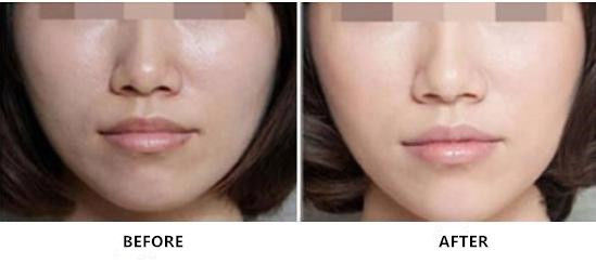 Non Cross Linked Sodium Hyaluronate Rejuvenating Injection สำหรับการดูแลผิว