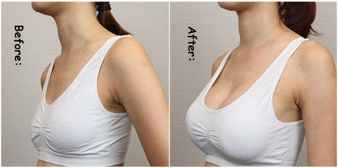 ฟิลเลอร์ฉีดหน้าอกด้วยกรดไฮยาลูโรนิกเต้านมโซเดียม Hyaluronate Enhancement Gel
