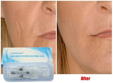 ฟิลเลอร์ฉีดกรดไฮยาลูโรนิก 10ml สำหรับฉีดริมฝีปากแก้มเสริมคาง