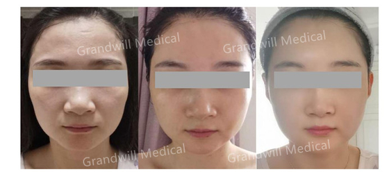 Hyaluronic Acid PCL Skin Booster มิราเคิลทัชอัพ Skin Collagen Stimulator