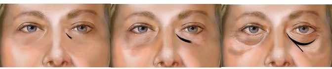 1ml 2ml สารละลายกรดไฮยาลูโรนิกแบบฉีดลบการรักษาความหมองคล้ำรอบดวงตา