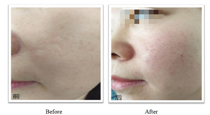 350 มิลลิกรัม 150 มิลลิกรัม PLLA Dermal Filler OEM การปรับแต่ง Plla ที่ฉีดเพื่อผลที่นานนาน