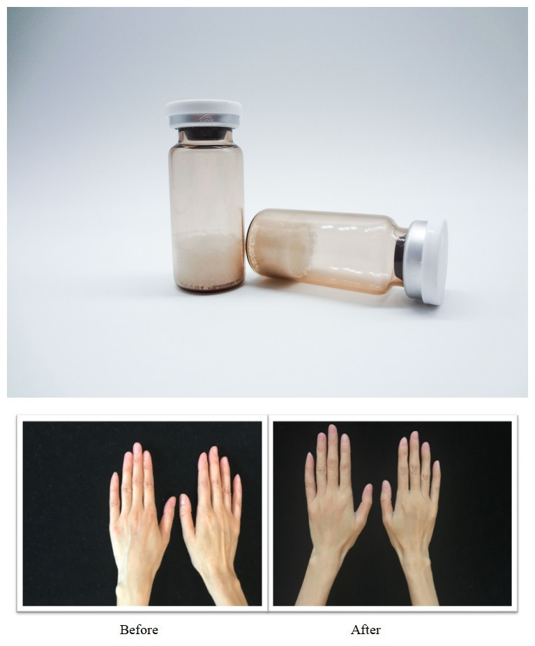 PLLA Hyaluronic Acid pCL PDRN สารเติมผิวหน้าสําหรับการผลิตคอลลาเจน การรักษาริ้วรอย